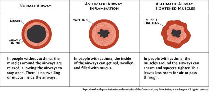Illustration comparing normal airways and asthmatic airways. 
Normal Airway: In people without asthma, the muscles around the airways are relaxed, allowing the airways to stay open. There is no swelling or mucus inside the airways.
Asthmatic Airway showing inflammation: In people with asthma, the inside of the airways can get red, swollen, and filled with mucus.
Asthmatic Airway showing tightened Muscles: In people with asthma, the muscles around the airways can spasm and squeeze tighter. This leaves less room for air to pass through.
Reproduced with permission from the website of the Canadian Lung Association, www.lung.ca. All rights reserved.