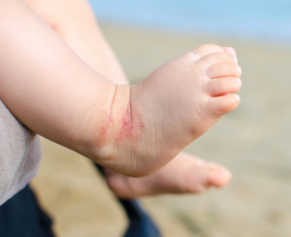 Closeup shot of infant's foot with a red rash