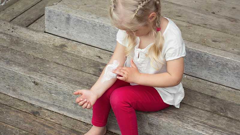 Girl applying cream on skin, eczema treatment.