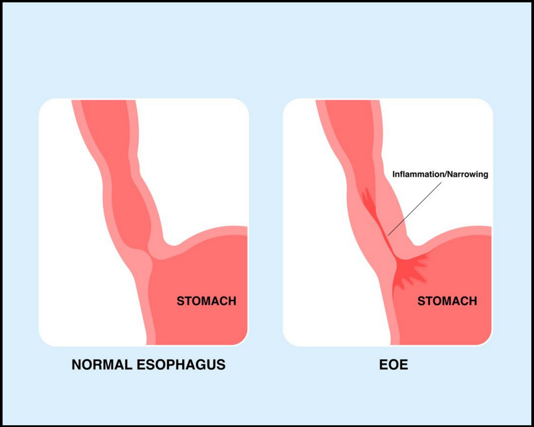 Eosinophilic Esophagitis Eoe Defined Food Allergy Canada 